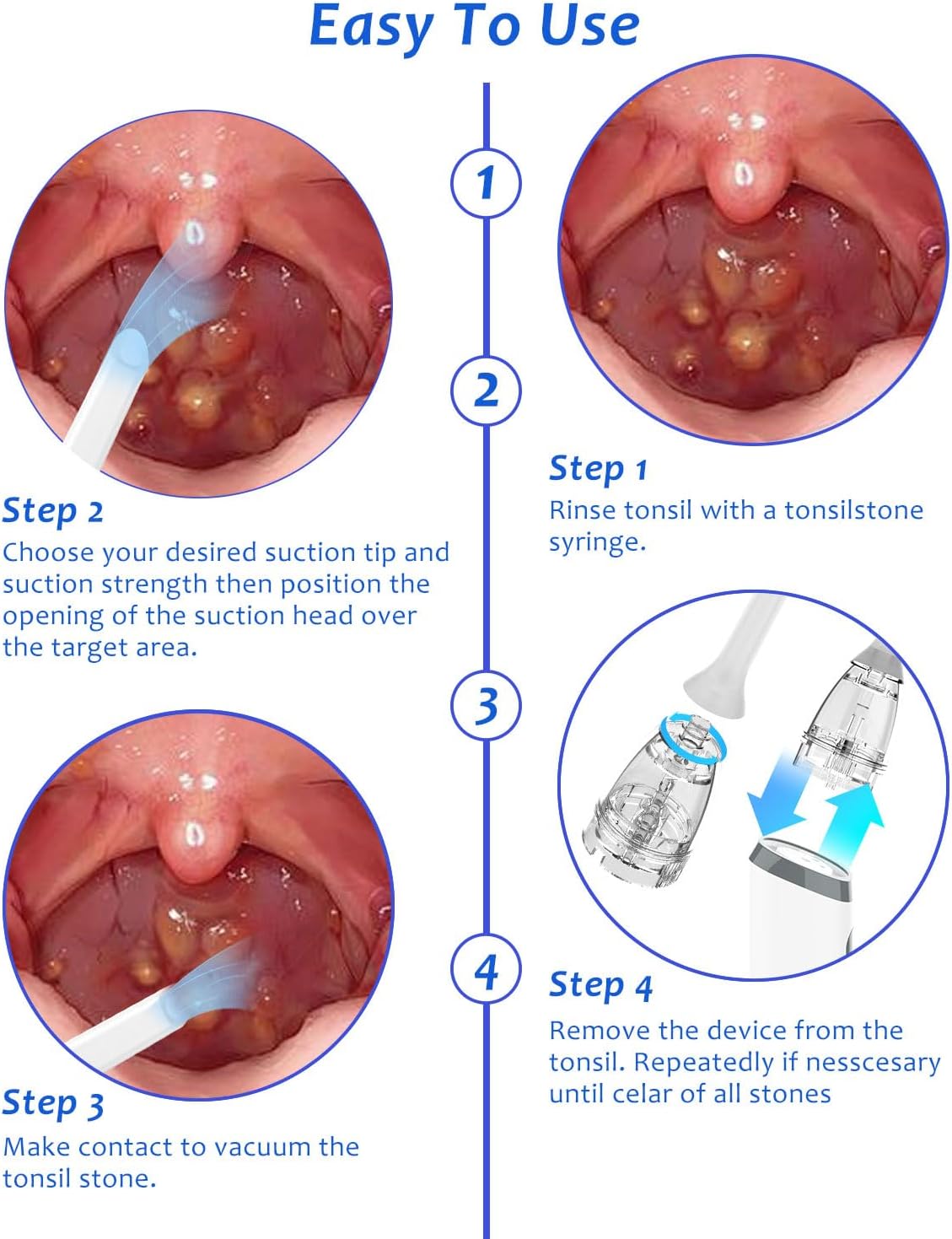 8 Zuigstanden 3 Niveaus Tonsil - Gadgets For Electronics recensie en prijs